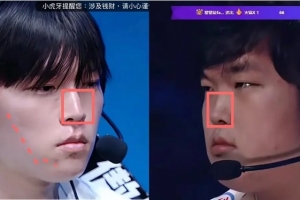 網友細扒Bin臉部變化細節：鼻梁變直變長；臉頰軟組織折疊變化